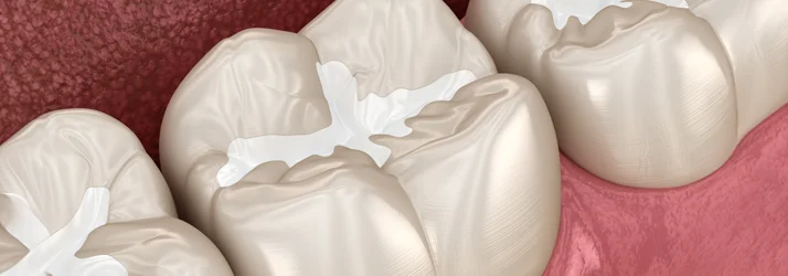 Pediatric Dental Fillings in Riverside CA